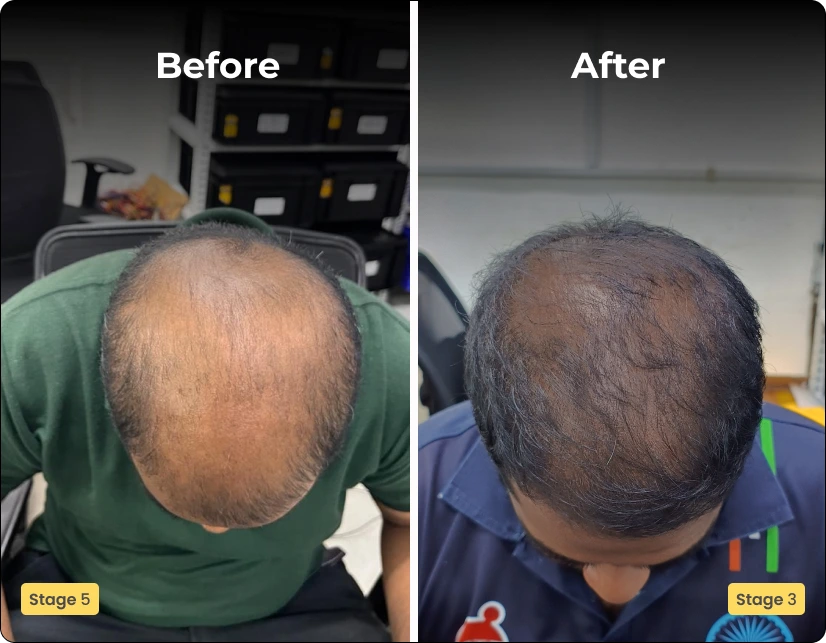 DermaQ Hair Loss Treatment Before After Results